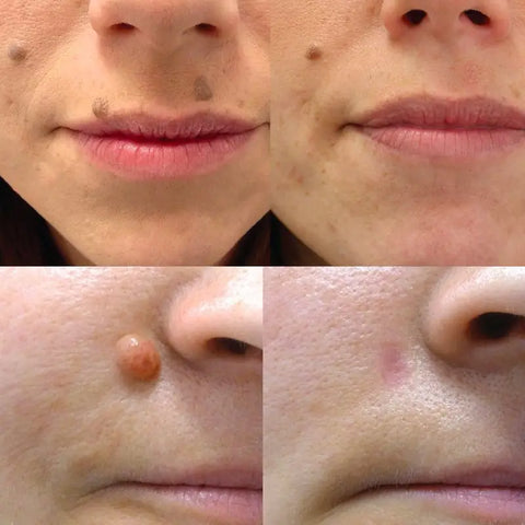 Stylo pour l’Elimination des Grains de Beauté - Novaa®