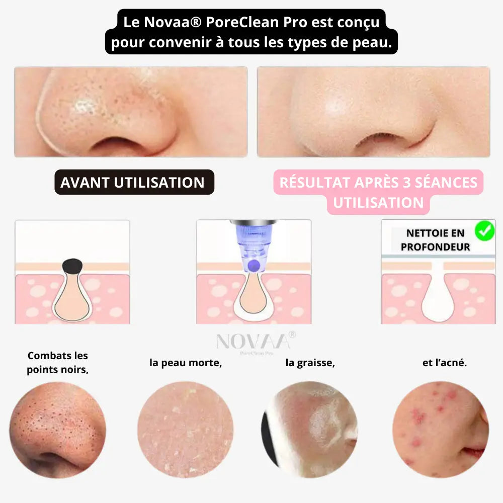 Aspirateur a points noirs du visage Novaa®