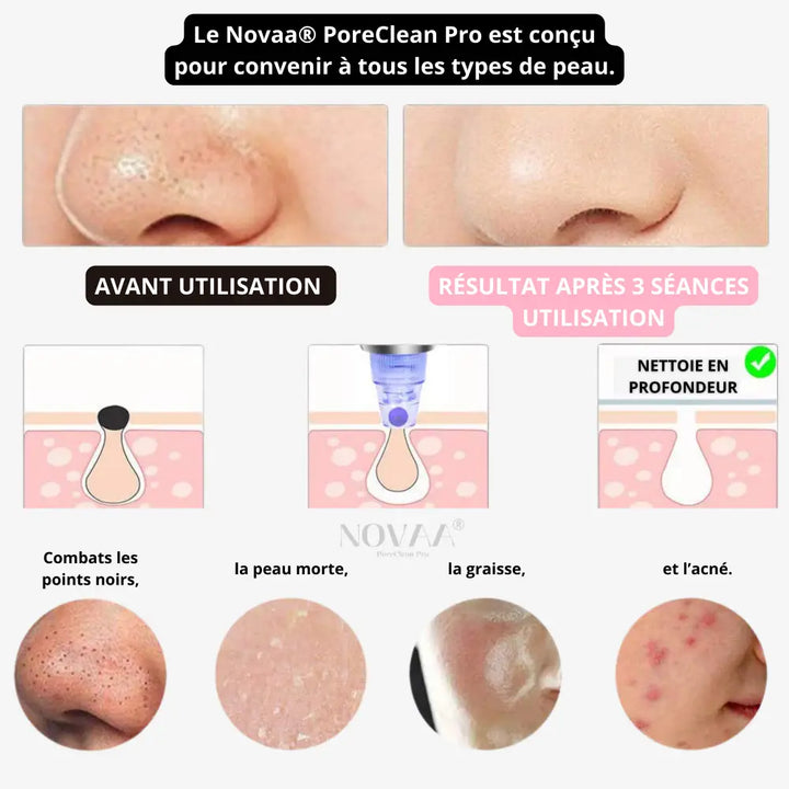 Aspirateur a points noirs du visage Novaa®