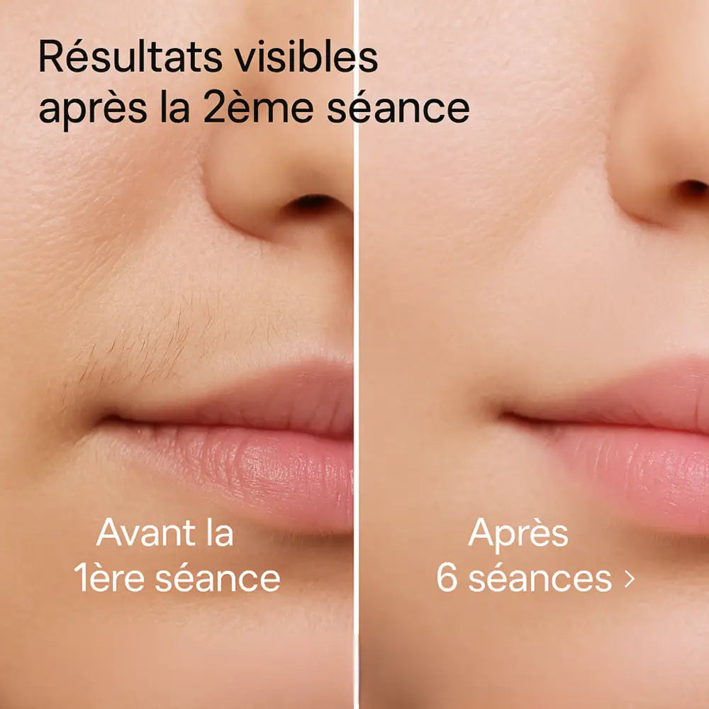 Épilateur IPL Novaa® Pro Expert – Épilation Définitive Corps & Visage