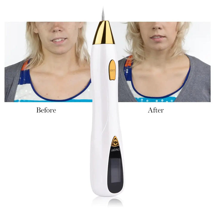 Stylo pour l’Elimination des Grains de Beauté - Novaa®